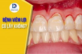 bệnh viêm lợi có lây không