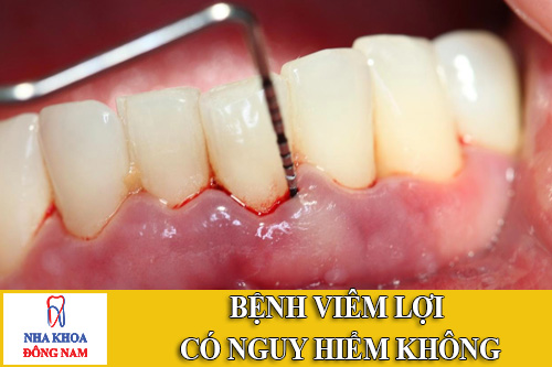 benh viem loi co nguy hiem khong