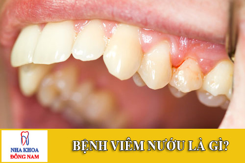 benh viem nuou la gi