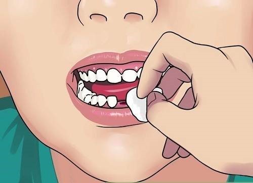 bị gãy răng thì làm cách nào để sơ cứu 2