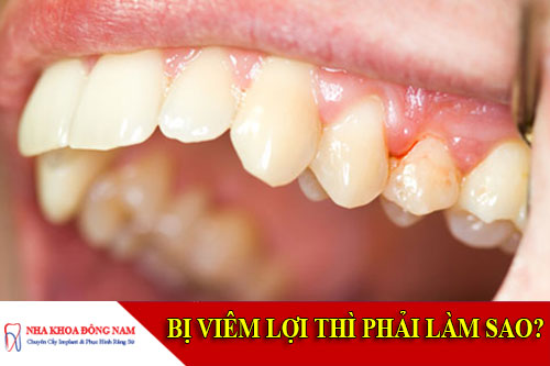 bị viêm lợi thì phai làm sao