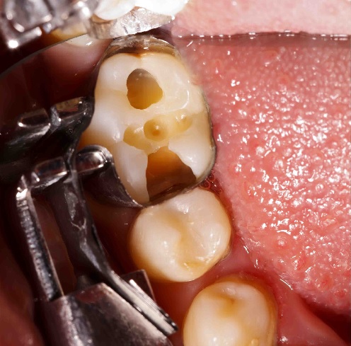 biến chứng của sâu răng