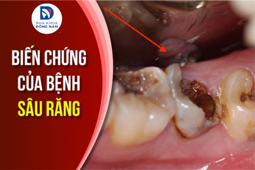 Biến chứng của bệnh sâu răng có ảnh hưởng đến sức khỏe không