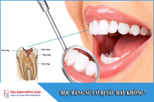 bọc răng sứ có bị sâu hay không