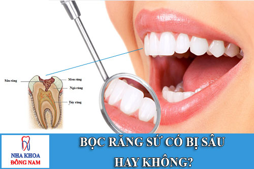 bọc răng sứ có bị sâu hay không