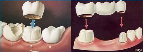 bọc răng sứ có cần mài 2 răng kế bên không 1