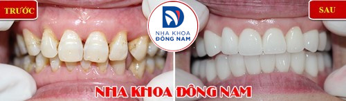 bọc răng sứ có cần mài 2 răng kế bên không 3
