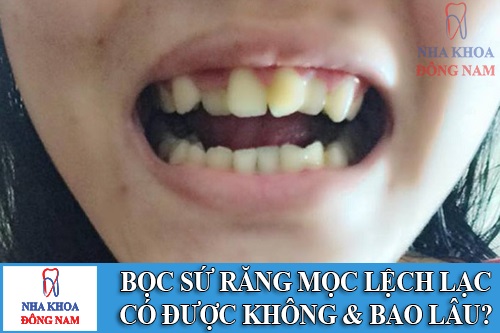 bọc sứ răng mọc lệch lạc được không và mất bao lâu -1
