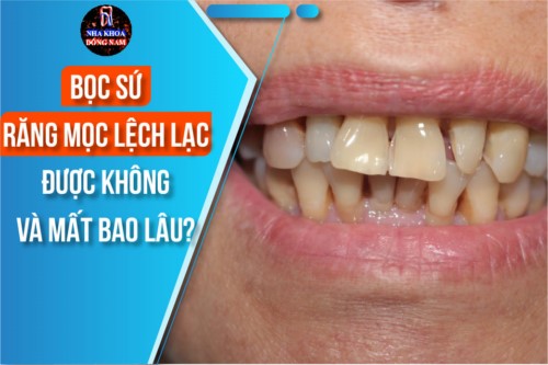 Bọc sứ răng mọc lệch lạc được không và mất bao lâu