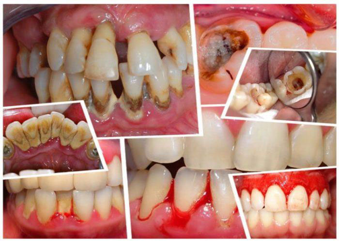 Các bệnh lý răng miệng cũng có thể gây mùi hôi khó chịu ở miệng