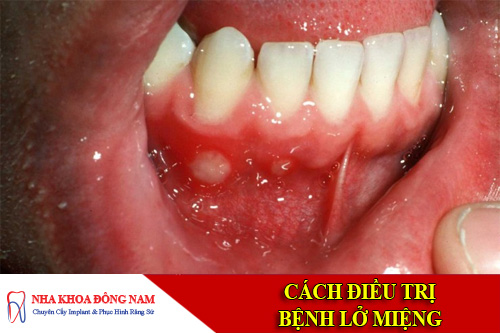 cach dieu tri benh lo mieng