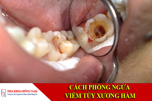Cách phòng ngùa viêm tủy xương hàm
