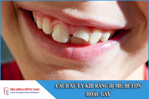 cách xử lý răng bị mẻ, bể lớn hoặc gãy