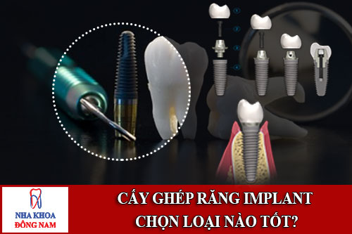 cấy ghép răng implant chọn loại nào tốt nhất