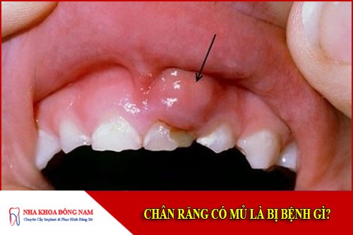 chân răng có mủ là bị bệnh gì