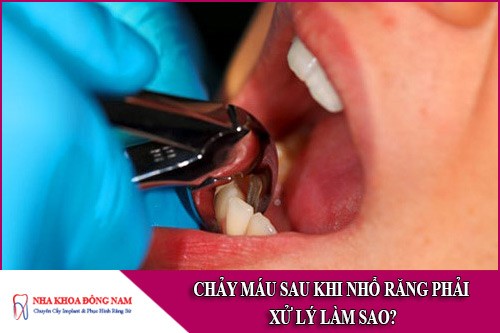 chảy máu sau khi nhổ răng phải xử lý làm sao
