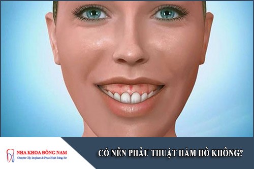 có nên phẫu thuật hàm hô không
