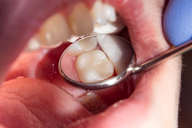 Composite có những đặc tính vật lý khác biệt với vật liệu sứ