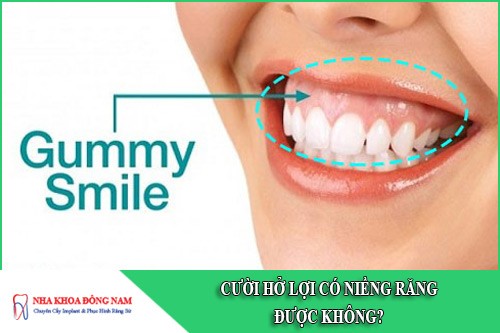 cười hở lợi có niềng răng được không
