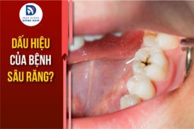 Dấu Hiệu Của Bệnh Sâu Răng