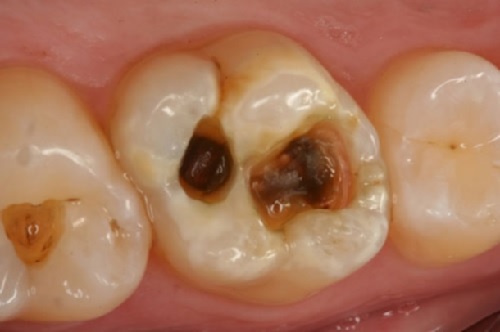 biểu hiện của sâu răng