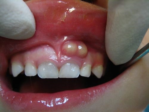 dấu hiệu sâu răng