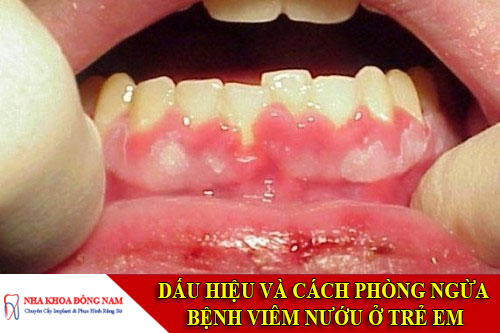 dấu hiệu và cách phòng ngừa bệnh viêm nướu ở trẻ em