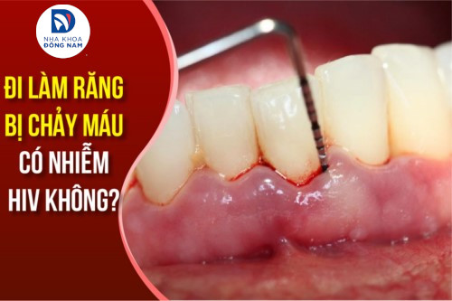 Đi làm răng bị Chảy Máu có nhiễm HIV không?