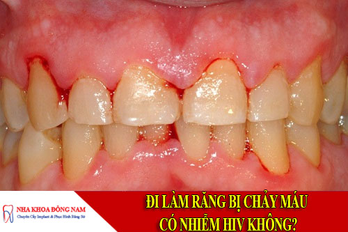 đi làm răng bị chảy máu có nhiễm hiv không