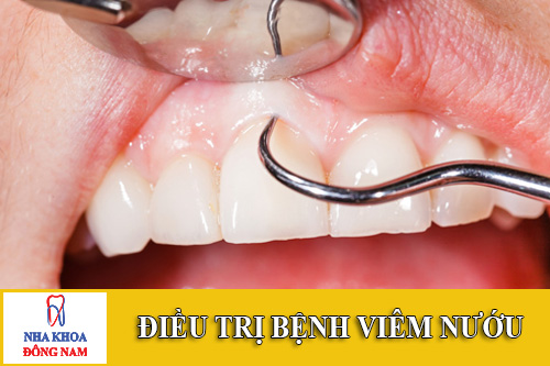 dieu tri benh viem nuou