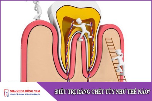 điều trị răng chết tủy như thế nào