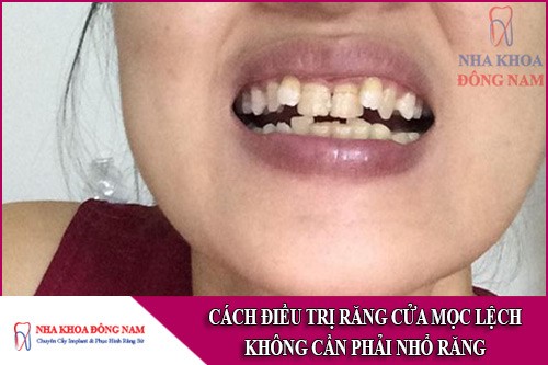 cách điều trị răng cửa mọc lệch mà không cần phải nhổ răng