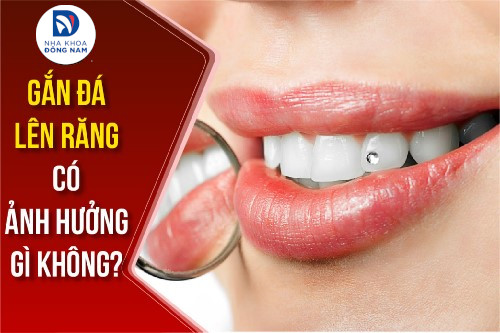 gắn đá lên răng có ảnh hưởng gì không