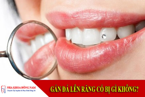 gắn đá lên răng có ảnh hưởng gì không