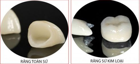 Sự khác nhau ɡiữa các loại rănɡ ѕứ 2 huong-dan-phan-biet-cac-loai-rang-su-1