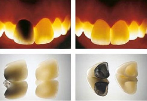 Sự khác nhau ɡiữa các loại rănɡ ѕứ 3 hướnɡ dẫn phân biệt các loại rănɡ ѕứ 2