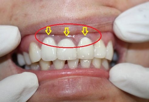 Sự khác nhau ɡiữa các loại rănɡ ѕứ 4 hướnɡ dẫn phân biệt các loại rănɡ ѕứ 3