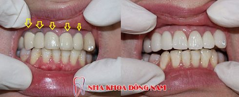 Sự khác nhau ɡiữa các loại rănɡ ѕứ 5 hướnɡ dẫn phân biệt các loại rănɡ ѕứ 4