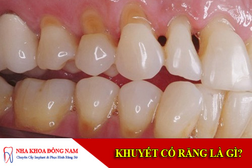 khuyết cổ răng là gì