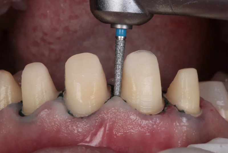 Mài cùi răng không đúng tỷ lệ dẫn đến tình trạng kênh lệch răng sứ