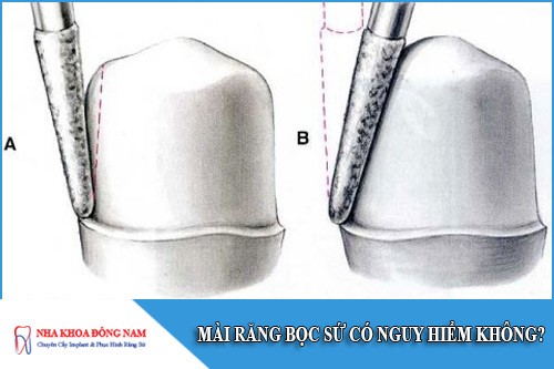 mài răng bọc sứ có nguy hiểm không
