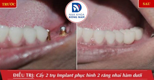 cấy implant răng hàm dưới