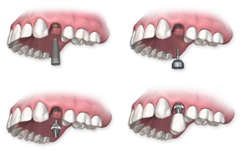 mô phỏng trồng răng implant