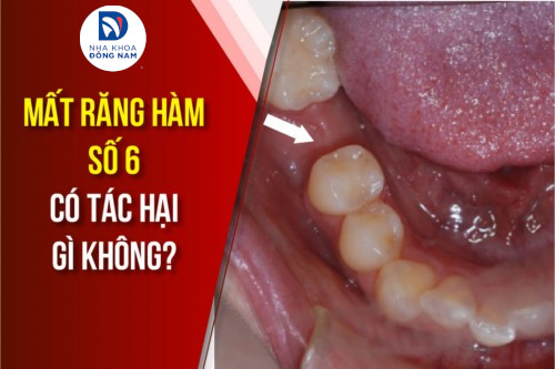 Mất răng có tác hại gì không?