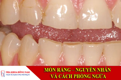 mòn rang nguyên nhan và cách phòng ngừa