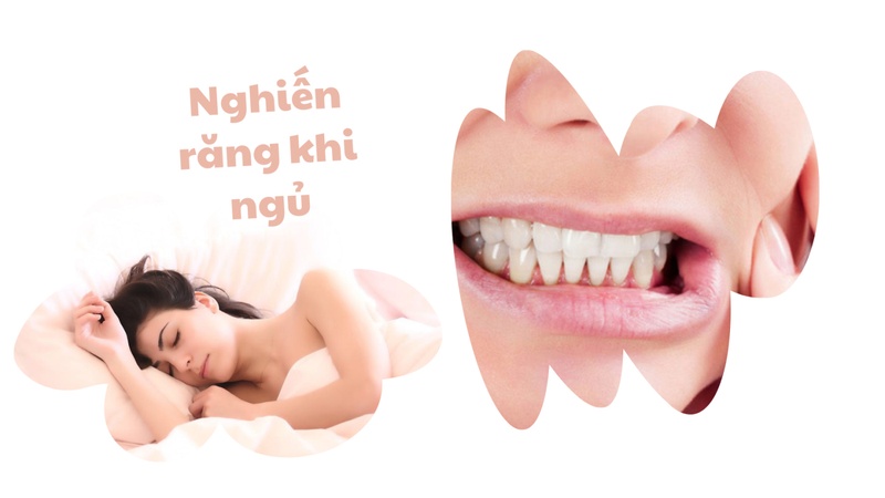 Nghiến răng khi ngủ gây mẻ, gãy răng sứ