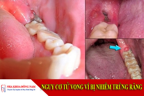 nguy cơ tử vong vì bị nhiễm trùng răng