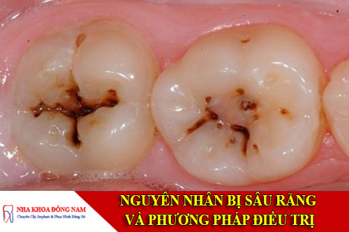 nguyên nhân bị sâu răng và phương pháp điều trị