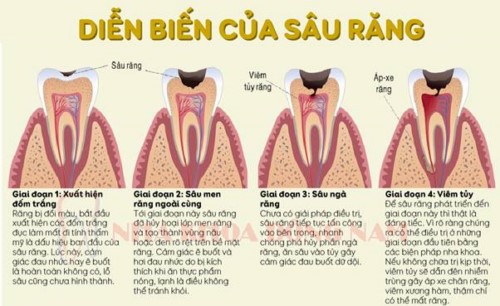 diễn biến của sâu răng