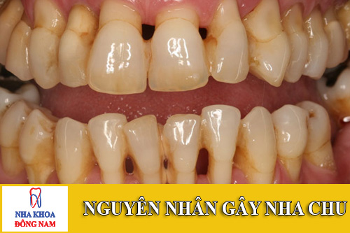 nguyên nhân gây bệnh nha chu